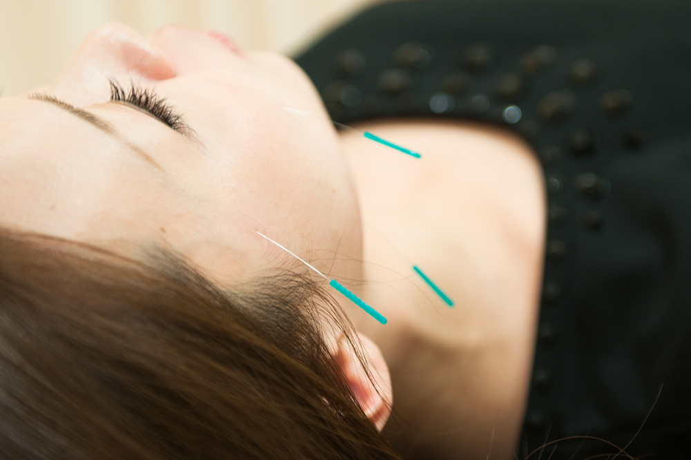 美容鍼で健康と美の両立をめざす